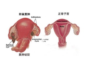 卵巢囊肿去做试管提高成功率的方法有哪些？