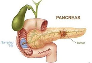 胰腺肿瘤的检查 