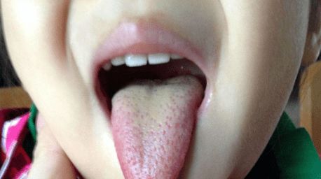 新生儿舌头发黄可是黄疸严重,宝宝舌头发黄