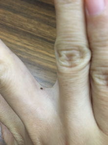 女人右手无名指侧面有痣代表什么