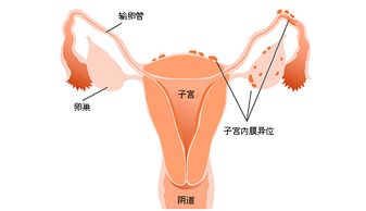 子宫内膜异位症能做试管婴儿吗？