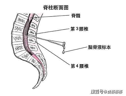 儿童做腰穿危险吗