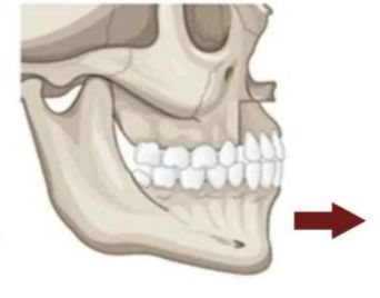 哪些牙齿做需要矫正,不矫正会有什么影响
