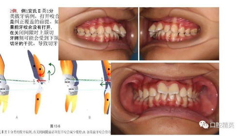 正畸临床打开咬合的方法讲义 