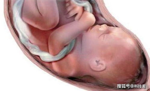 胎儿脐带绕颈两圈严重吗应该怎么办(胎儿脐带绕颈二圈会有危险吗)