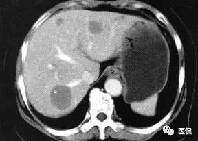 反复腹痛恶心,肝的问题 增强CT看见肝内有结节,是什么 
