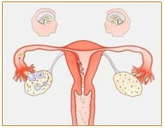 特发性卵巢早衰是什么，可以试管助孕吗？