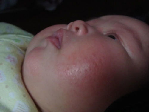 婴儿湿疹的原因，婴儿湿疹是什么原因