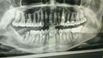 请专家帮我看看,下面那个断了的大牙需不需要拨 
