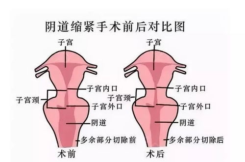 私密整形 阴道紧缩术让你重获紧致和性福