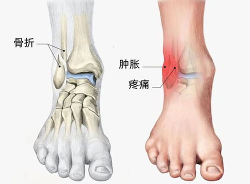 崴脚后一直肿,是不是骨折了,医生教你分辨