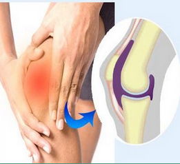 膝关节炎有什么症状(膝盖关节炎的症状有哪些)