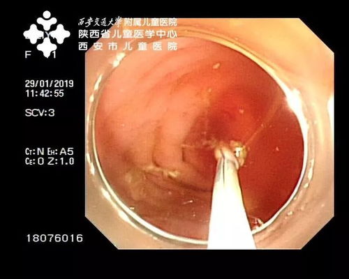 保住阑尾 治疗炎症 全国领先的内镜下阑尾炎治疗术 ERAT