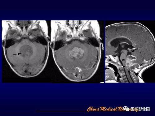 脑室内肿瘤影像诊断丨影像天地 