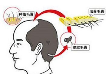 为什么秃顶的人多植发的人少 难道植发不管用