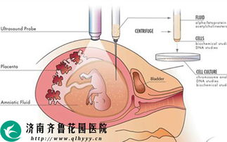 孕期进行羊水穿刺可以查出什么