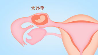试管助孕是直接把胚胎移植进去？还会出现宫外孕吗？