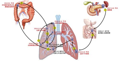 胰腺癌活不过1年 这位老太太复发6次,如何带瘤生活超10年