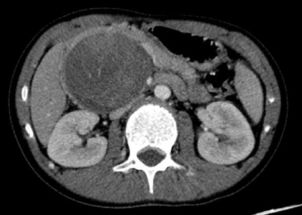 这种巨大胰腺肿瘤手术完整切除即可治愈,术后无需化疗