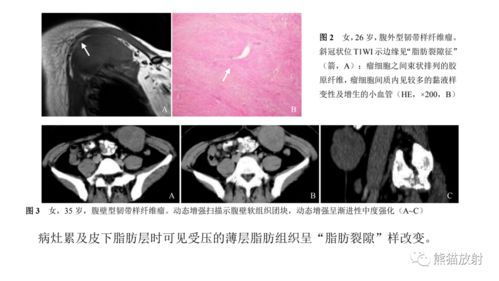 骨及软组织肿瘤 21.09