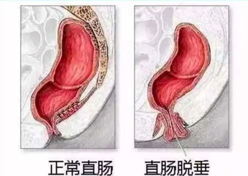 知识科普丨丨直肠脱垂怎么回事