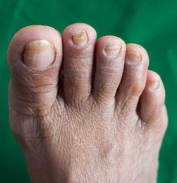脚指甲变黑是怎么回事 警惕灰指甲疾病来袭