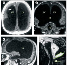 大脑 天性脑囊肿医生说的不一样看了三个两个叫做手术一个说不用做您说怎么办做了个磁共振