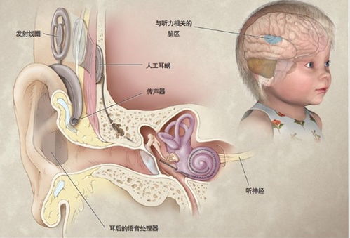 澳大利亚人工耳蜗最新上市的是什么型号？多少钱？？