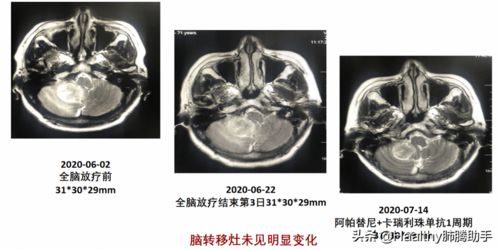 50 的肺癌患者逃不过脑转移 三甲医生解读 保命 方案