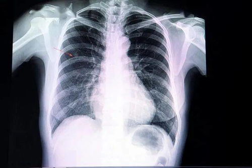 肺部发现小结节,是不是得肺癌了 查出肺部小结节,该怎么办