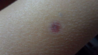 红印疤痕用什么能去除 我手臂上有个圆圆的红印 