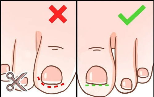 涨知识 如何正确修脚趾甲