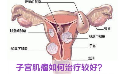 粘膜下子宫肌瘤的治疗价格