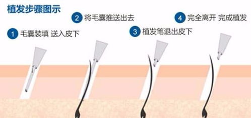 上海最好的植发医de院哪家啊？