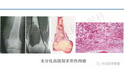 骨肿瘤第4版WHO病理分类浅析与影像诊断