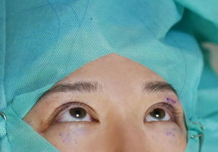 人间医美 关于双眼皮埋线手术和眼部抽脂的 实力 分享