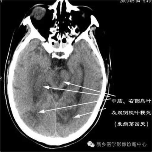 基底动脉尖综合征