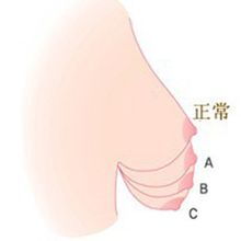 注意 冬季不穿文胸会导致乳房下垂 