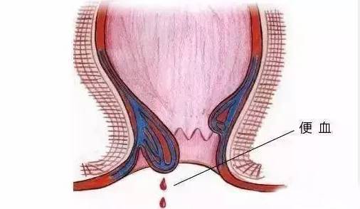 青岛京北肛肠医院表示有了这六种症状一定要去医院,肛肠疾病别扛着