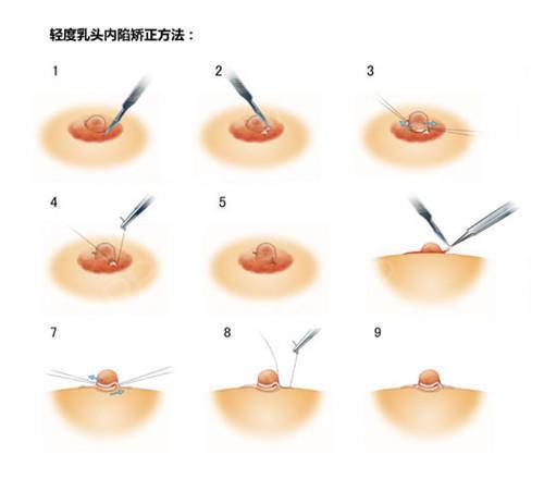 乳头内陷的原因及治疗