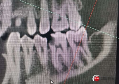 后牙嵌体修复