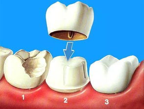 补牙大不同,合生齿科Dr.贾维良带您了解龋齿的几种治疗方法