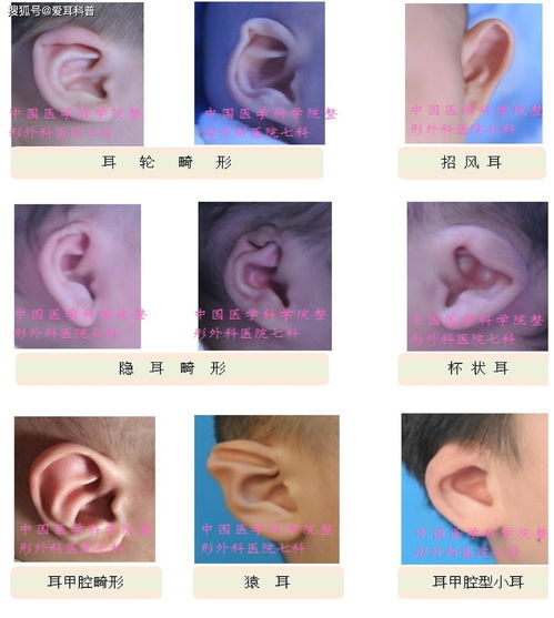 没有外耳廓是什么耳朵