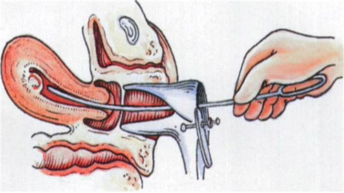 刮宫对身体伤害大吗,刮宫后注意事项