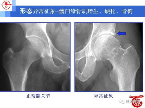 股髋撞击综合征 FAI 影像学诊断