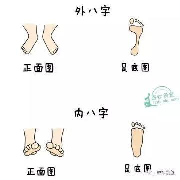 1岁宝宝走路内八字 IU八字