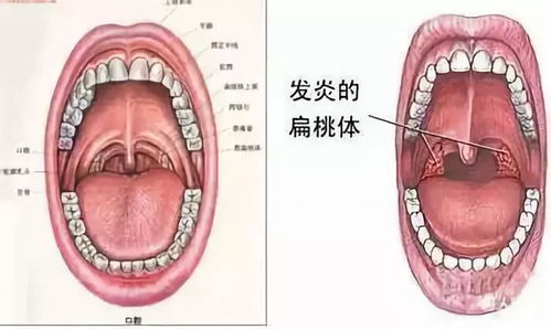 天呐 男子猛烈咳嗽后,竟咳出自己的扁桃体 这些信号千万别忽视