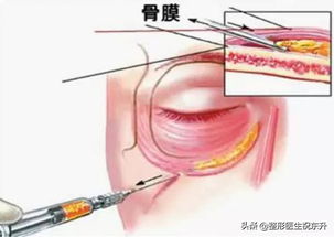 为什么医生不建议脂肪填充泪沟(脂肪填充泪沟肿胀为什么不爱吸收)