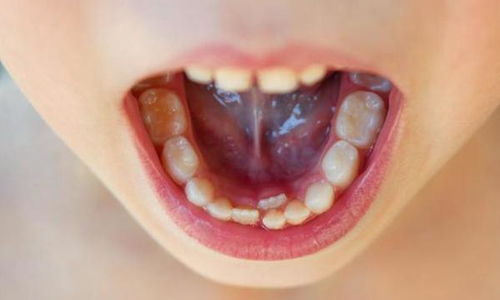 孩子出现双排牙,需不需要将乳牙拔掉 医生提醒 要视情况而定