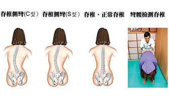 整个脊椎矫正怎么弄好看 脊柱矫正怎么做
